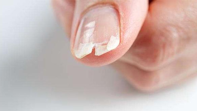 کم خونی از دلایل شکستن ناخن