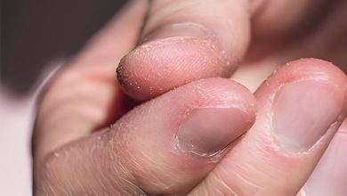 علت پوسته شدن دور ناخن