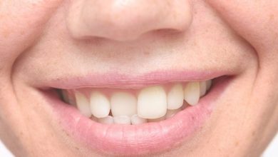 ارتودنسی تک دندان کج: چگونه دندان کج را صاف کنیم؟